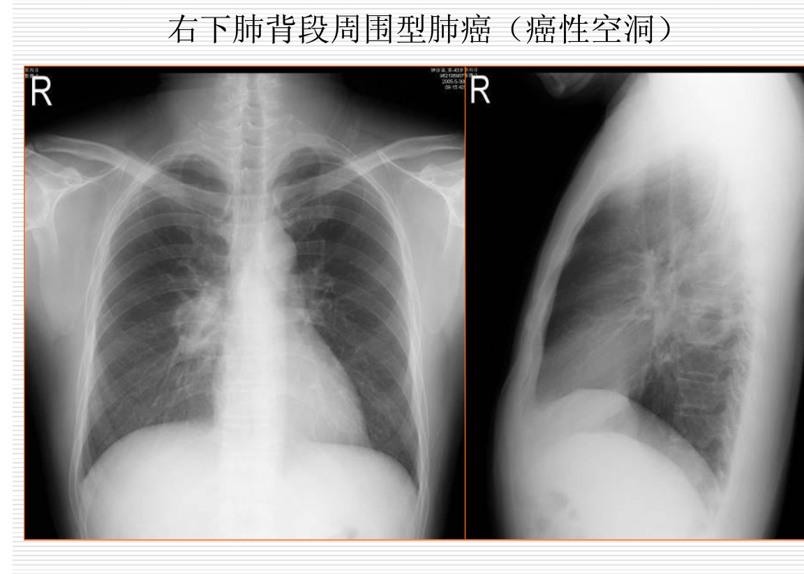 常见疾病的X线与CT诊断学