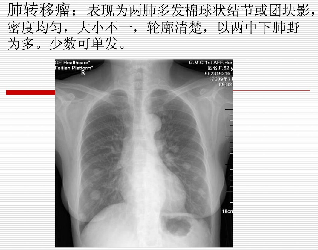 常见疾病的X线与CT诊断学