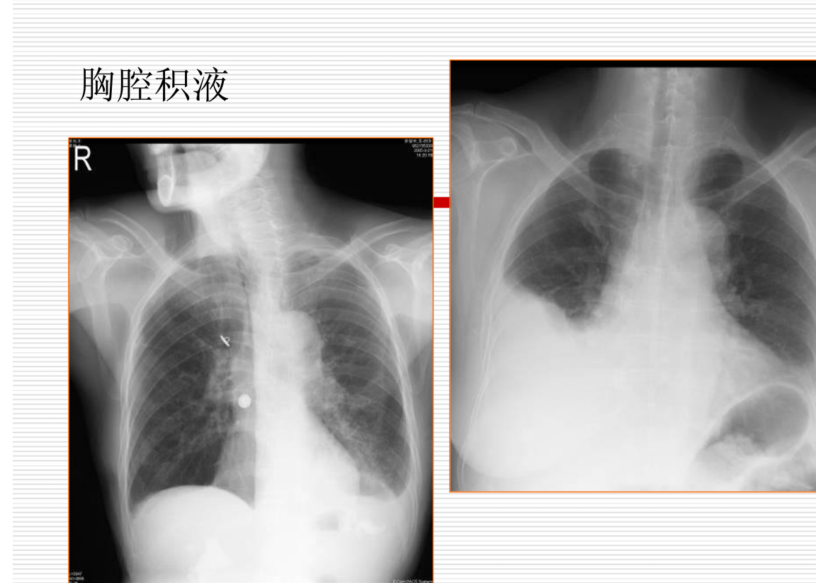 常见疾病的X线与CT诊断学