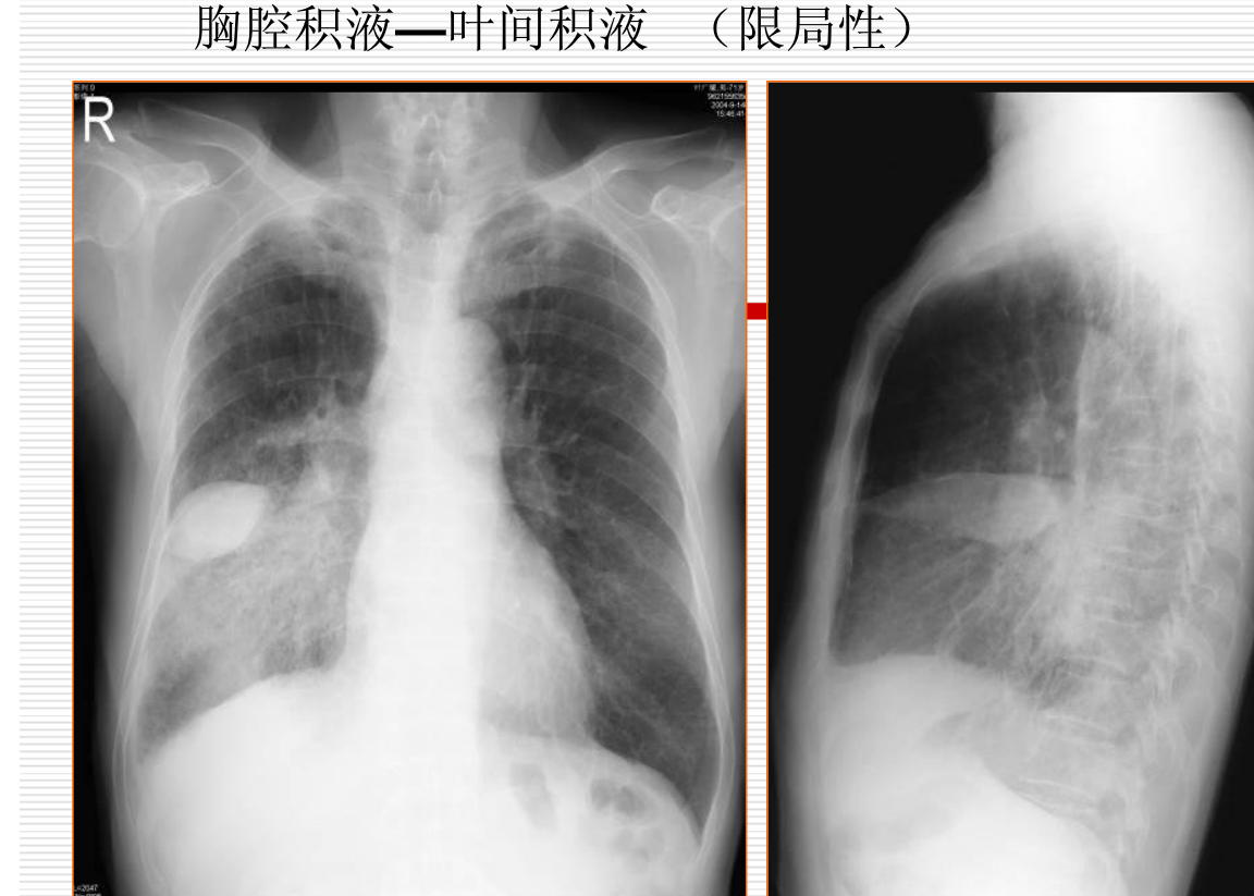 常见疾病的X线与CT诊断学
