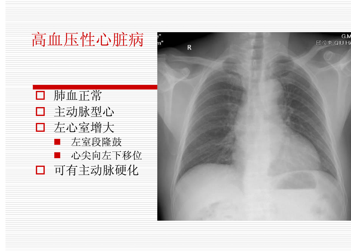 常见疾病的X线与CT诊断学