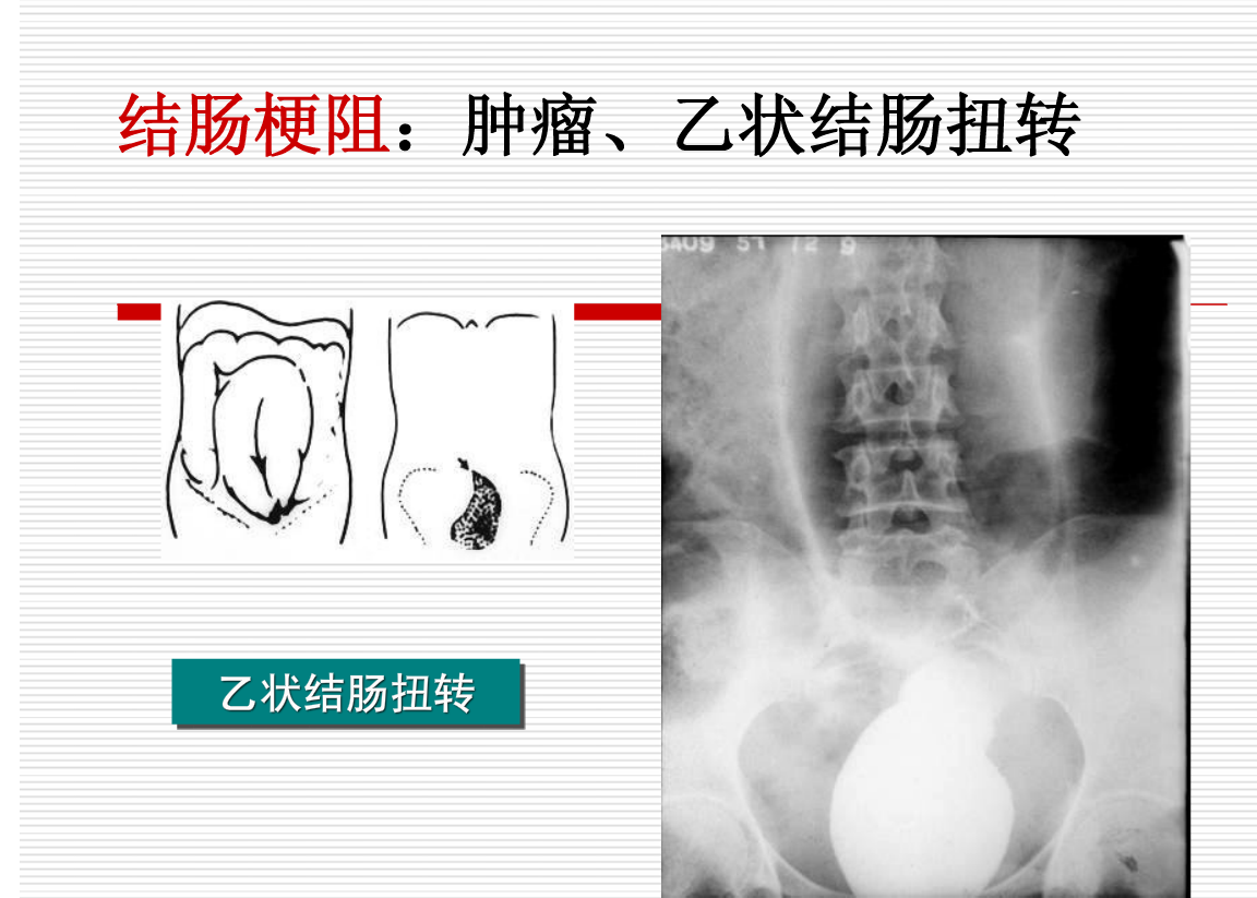 常见疾病的X线与CT诊断学