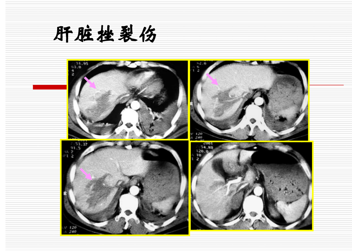 常见疾病的X线与CT诊断学