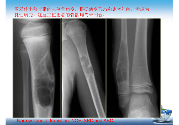 骨肿瘤影像学鉴别诊断