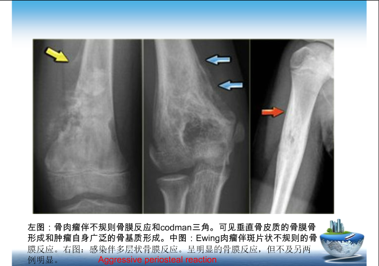骨肿瘤影像学鉴别诊断