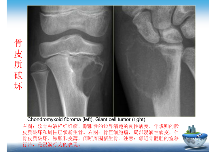 骨肿瘤影像学鉴别诊断