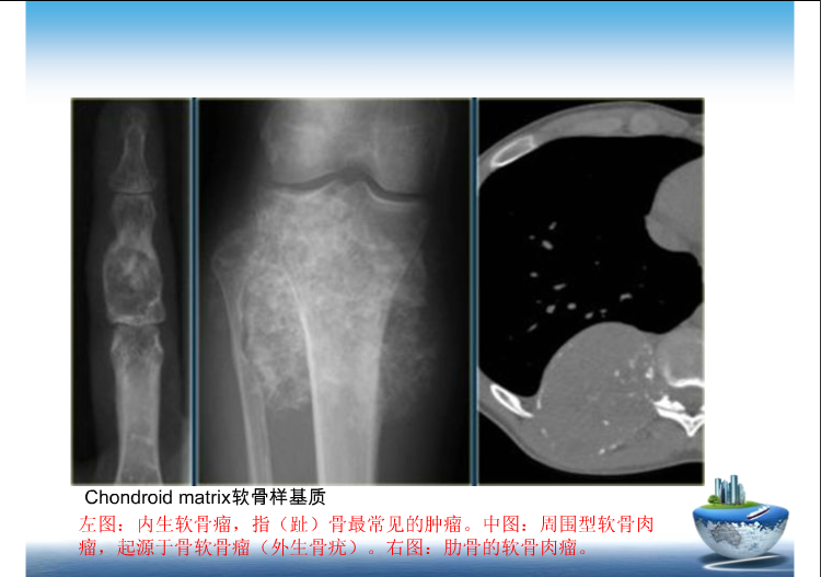 骨肿瘤影像学鉴别诊断