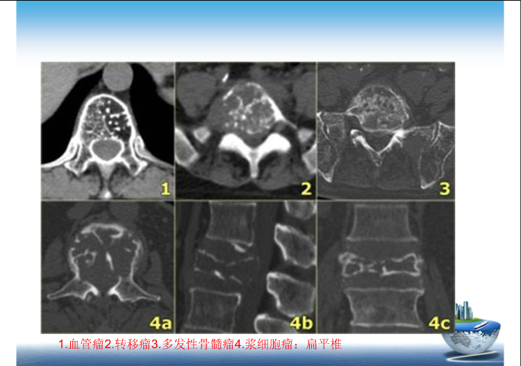 骨肿瘤影像学鉴别诊断