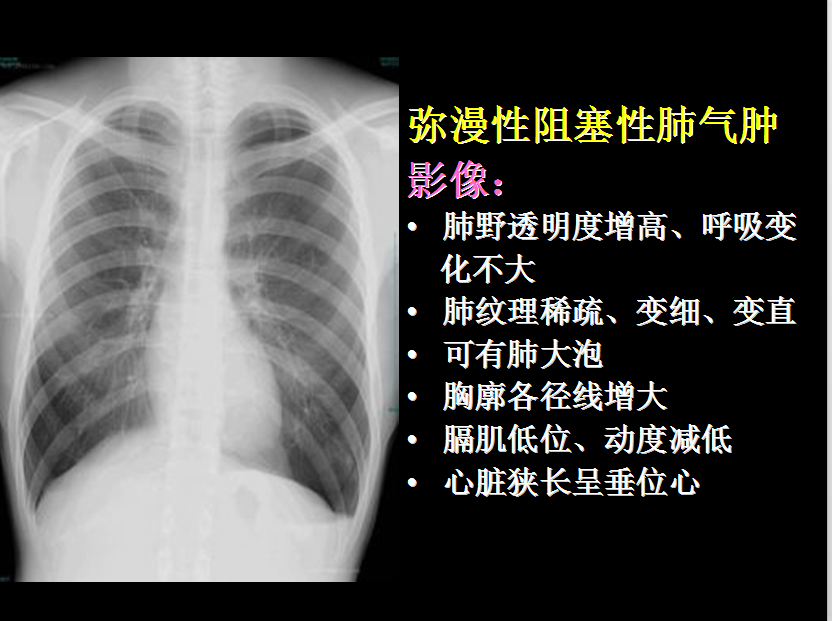 呼吸系统疾病X线诊断