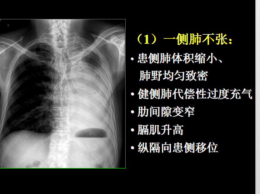 呼吸系统疾病X线诊断