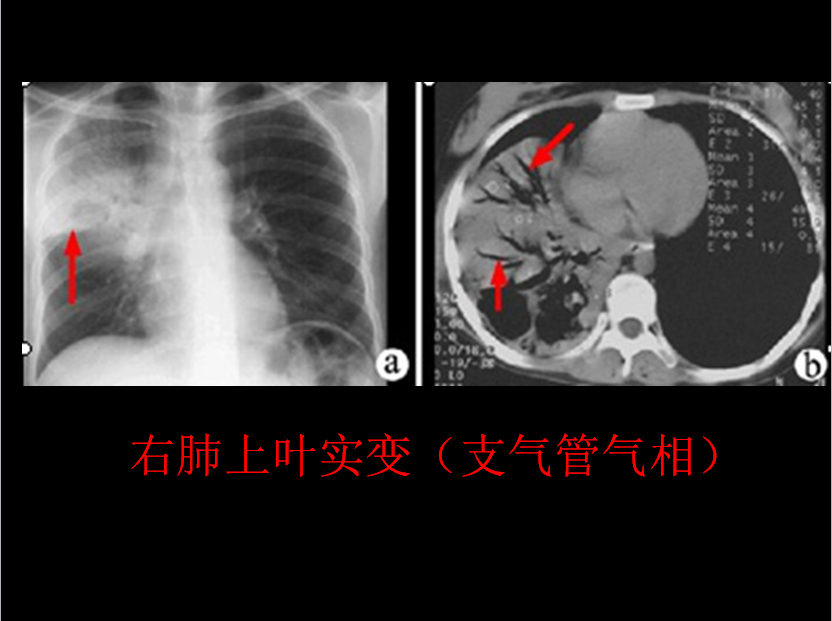 呼吸系统疾病X线诊断