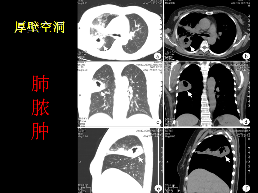 呼吸系统疾病X线诊断