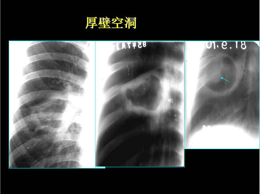 呼吸系统疾病X线诊断