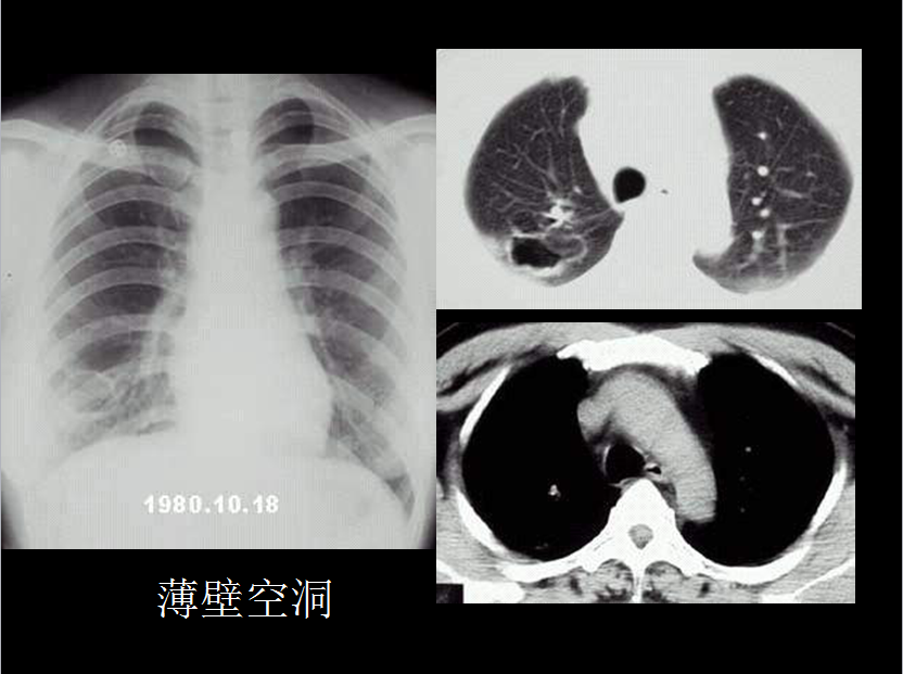 呼吸系统疾病X线诊断