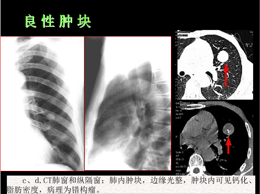 呼吸系统疾病X线诊断
