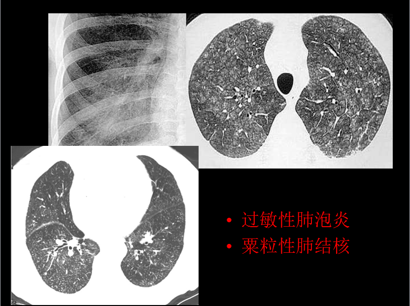 呼吸系统疾病X线诊断