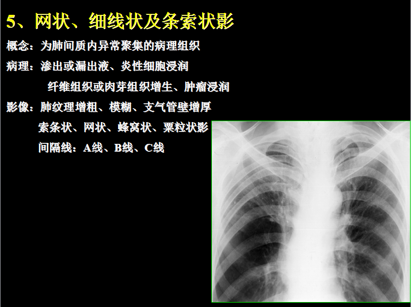 呼吸系统疾病X线诊断