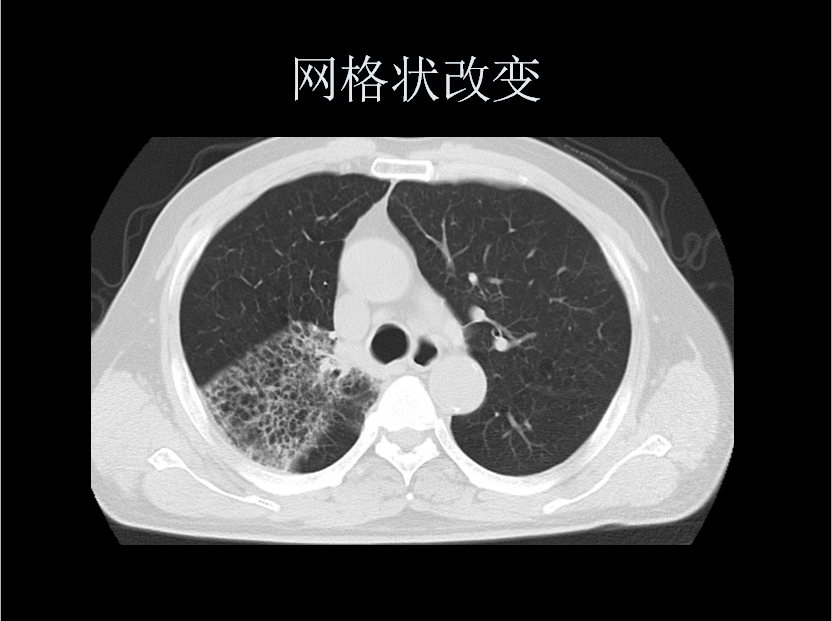 呼吸系统疾病X线诊断