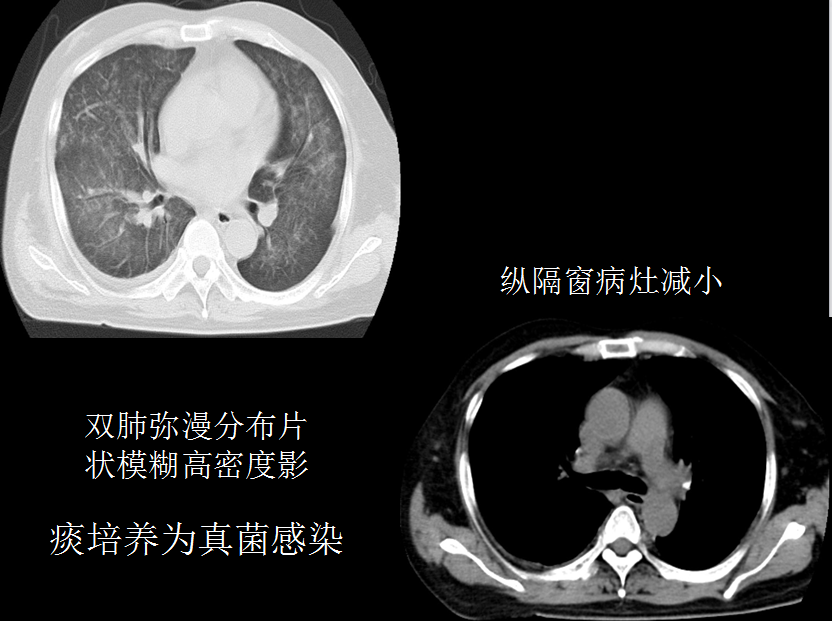 呼吸系统疾病X线诊断