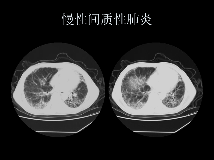 呼吸系统疾病X线诊断
