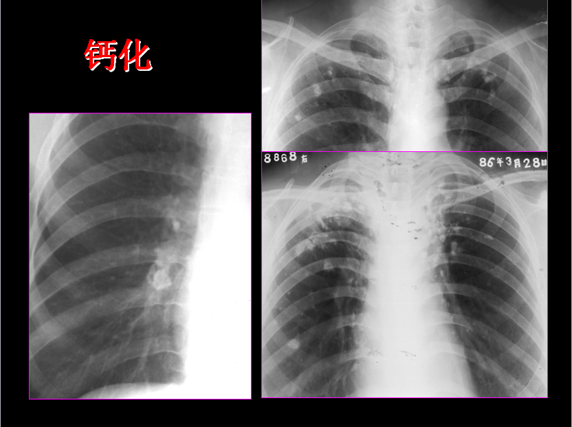 呼吸系统疾病X线诊断