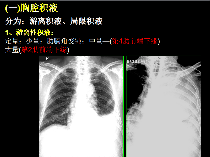 呼吸系统疾病X线诊断