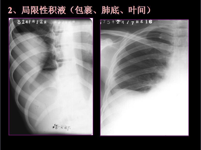 呼吸系统疾病X线诊断