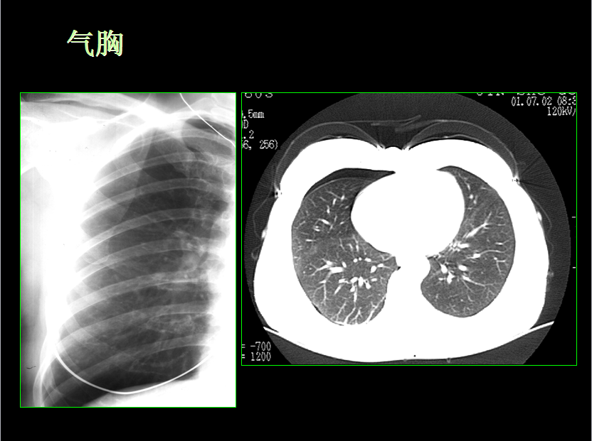 呼吸系统疾病X线诊断