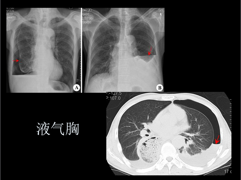 呼吸系统疾病X线诊断