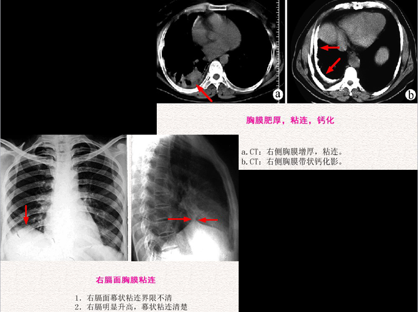 呼吸系统疾病X线诊断