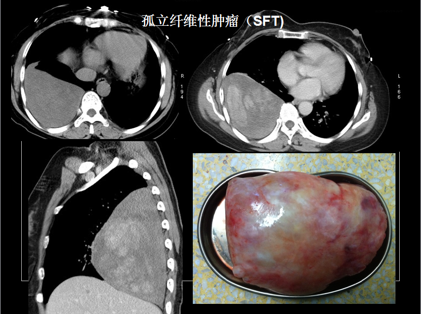 呼吸系统疾病X线诊断