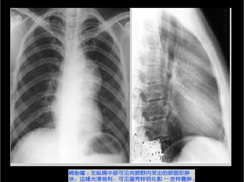 呼吸系统疾病X线诊断