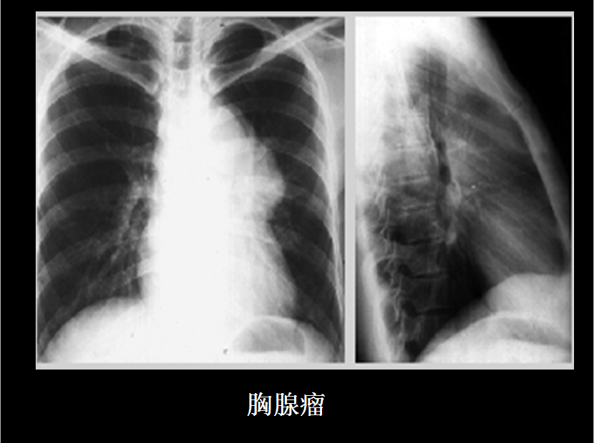 呼吸系统疾病X线诊断