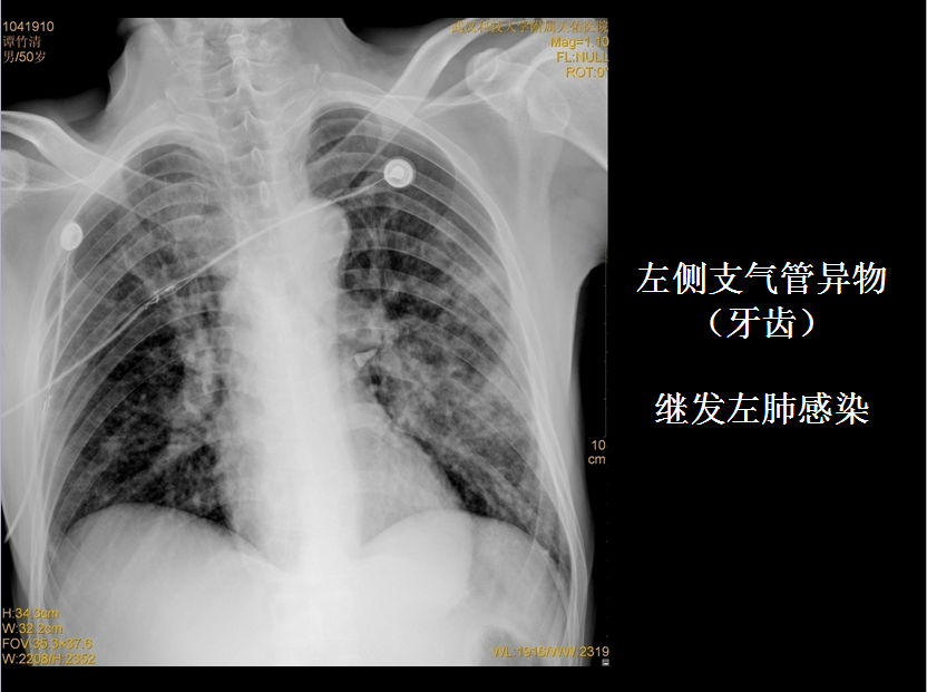 呼吸系统疾病X线诊断