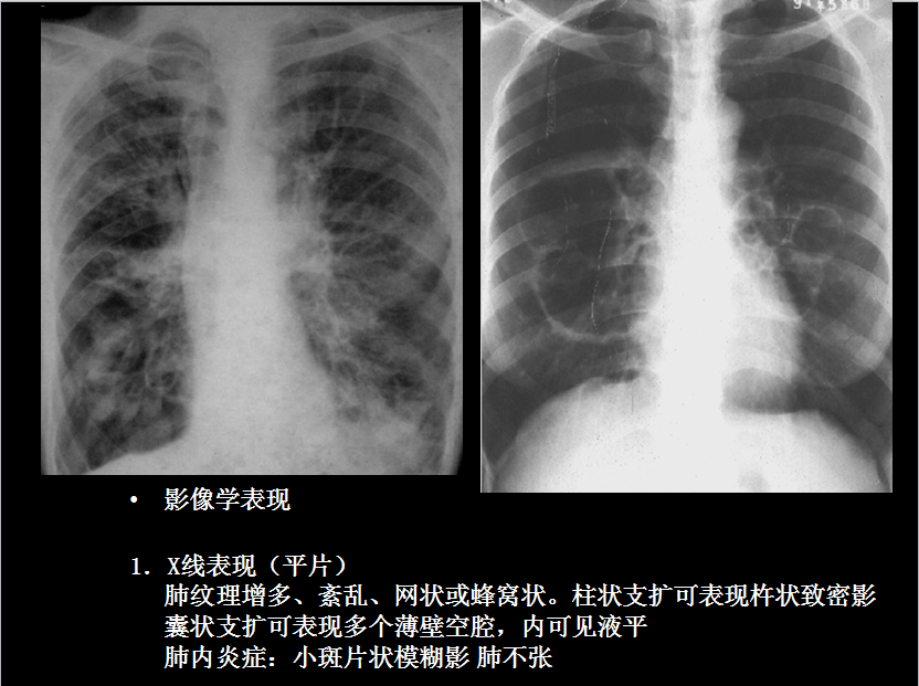呼吸系统疾病X线诊断