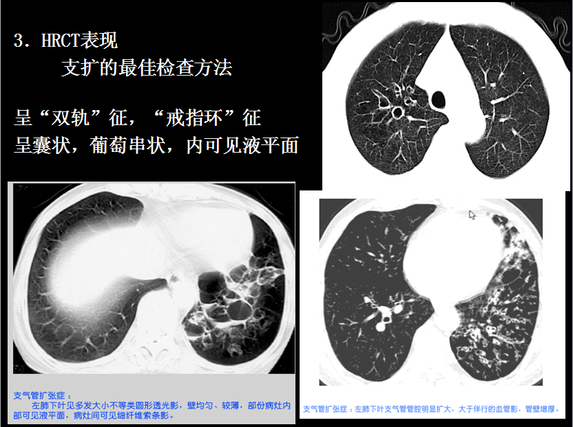 呼吸系统疾病X线诊断