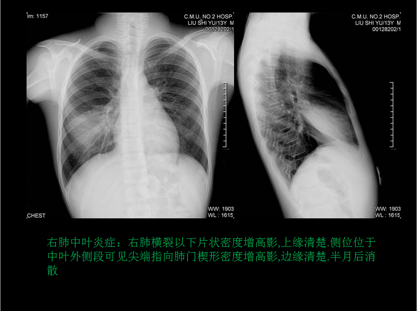 呼吸系统疾病X线诊断