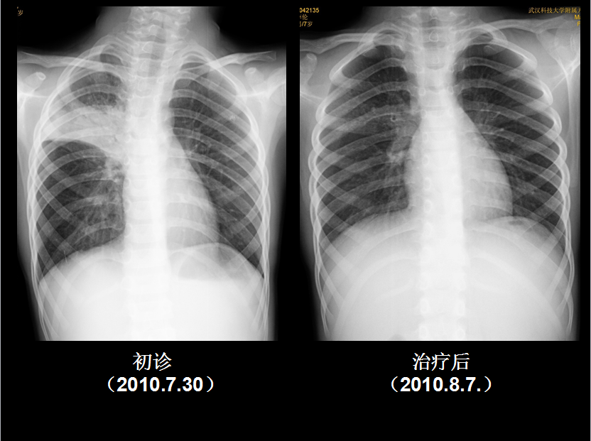 呼吸系统疾病X线诊断