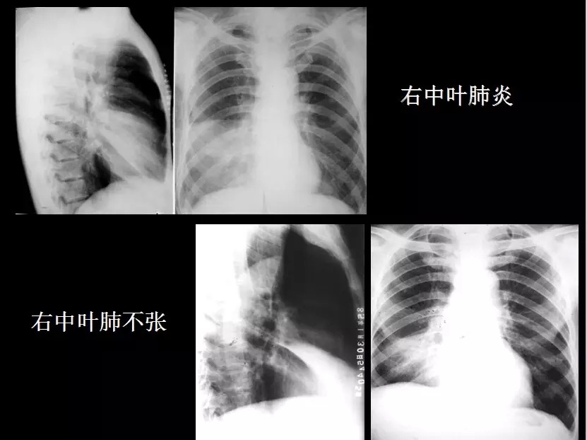 呼吸系统疾病X线诊断