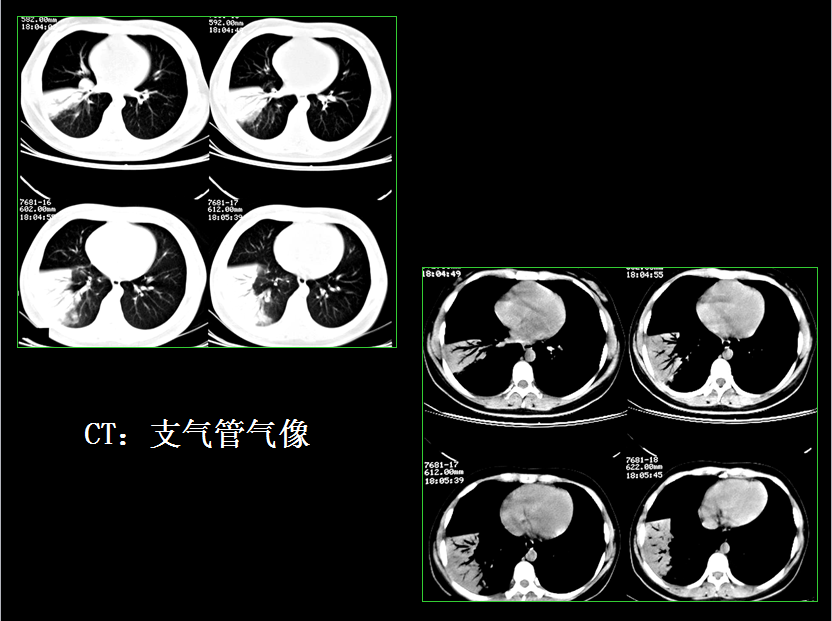 呼吸系统疾病X线诊断