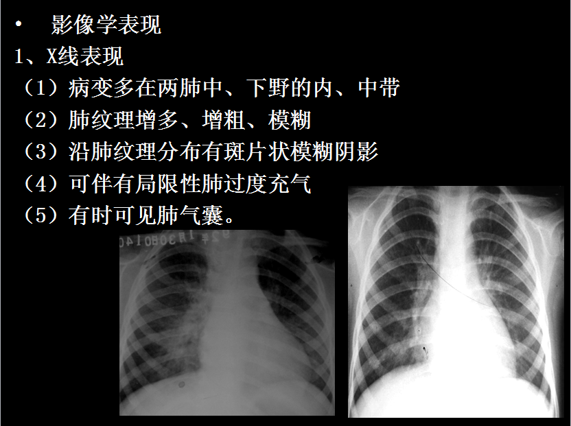 呼吸系统疾病X线诊断