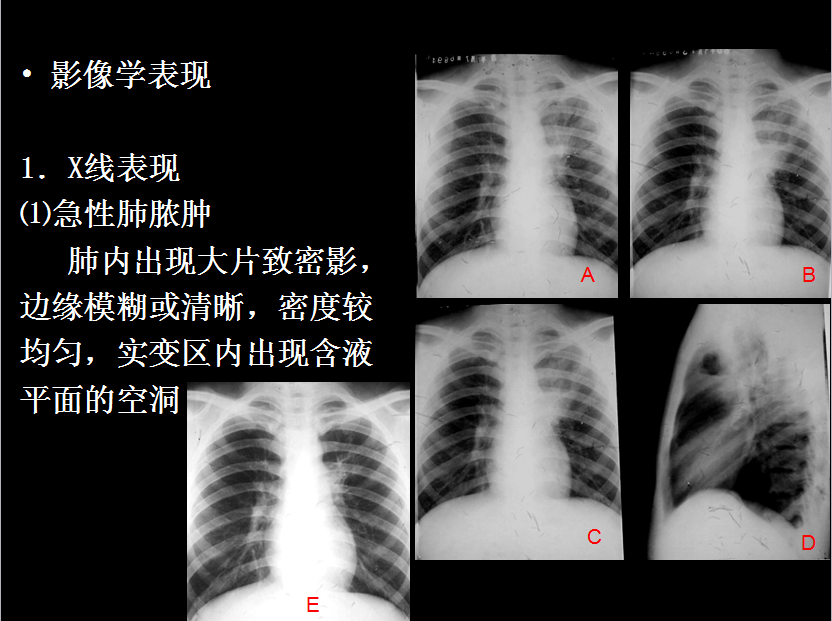 呼吸系统疾病X线诊断