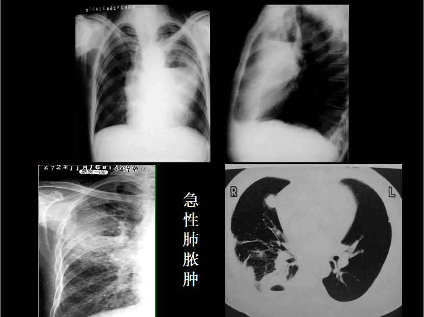 呼吸系统疾病X线诊断