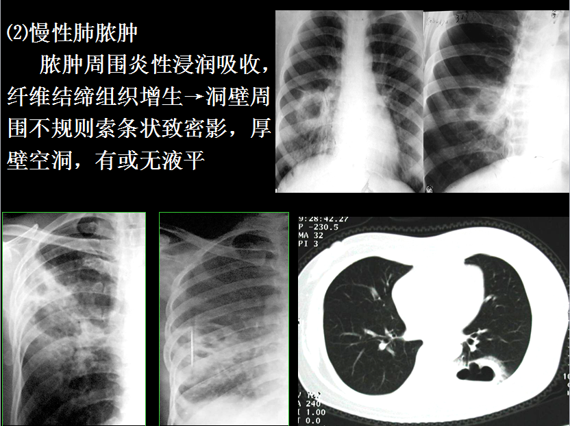 呼吸系统疾病X线诊断