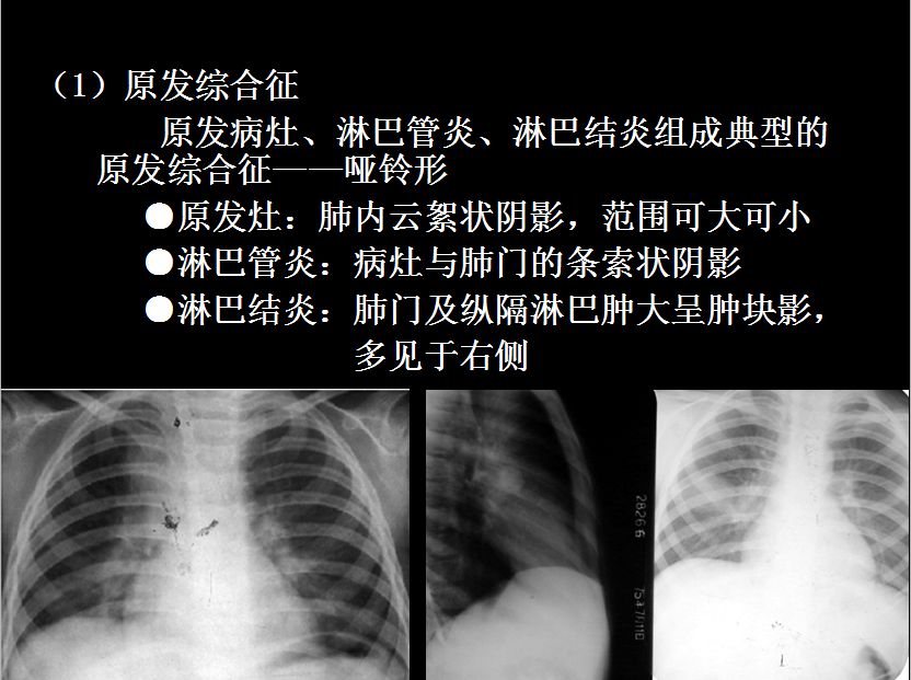 呼吸系统疾病X线诊断