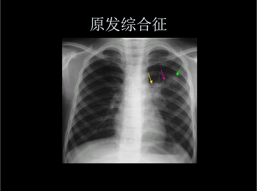 呼吸系统疾病X线诊断