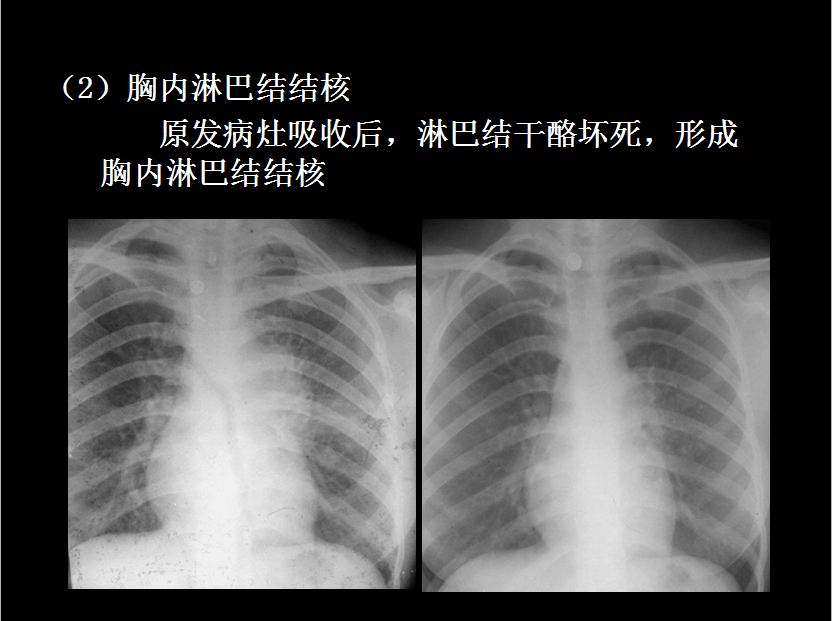 呼吸系统疾病X线诊断