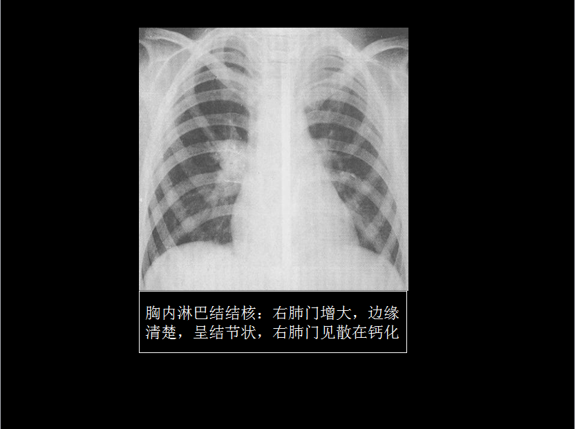 呼吸系统疾病X线诊断