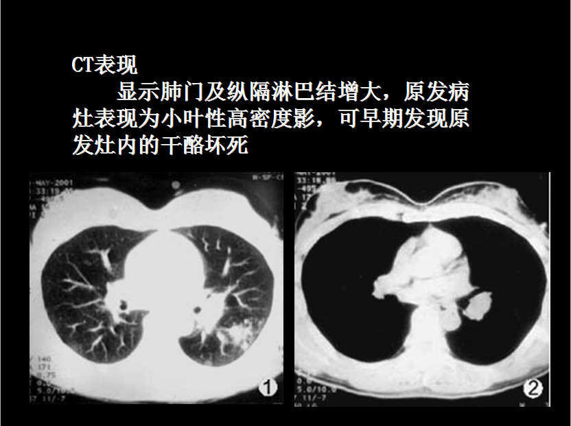 呼吸系统疾病X线诊断