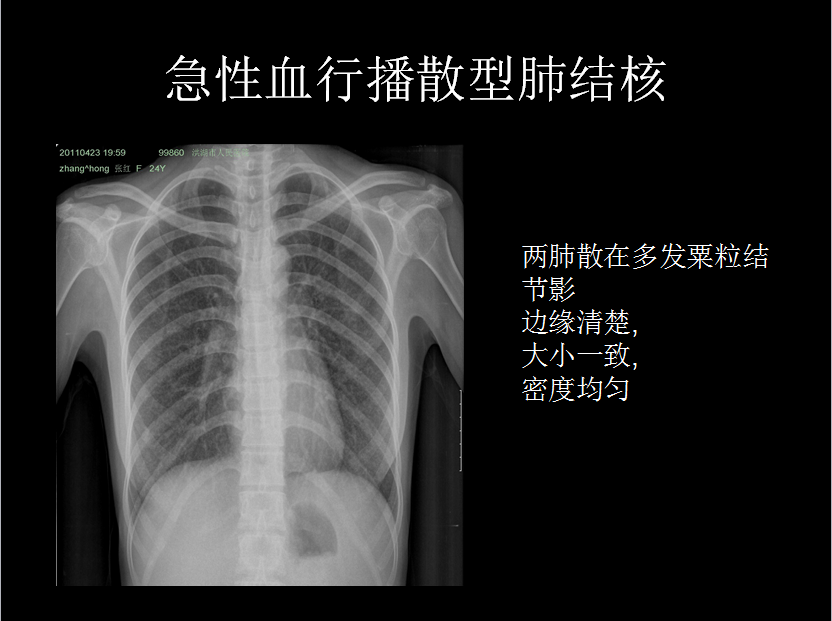 呼吸系统疾病X线诊断